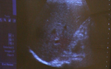 Ultrasound