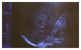 Ultrasound